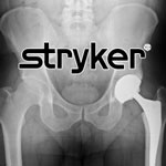 Stryker Rejuvenate Lawsuit 