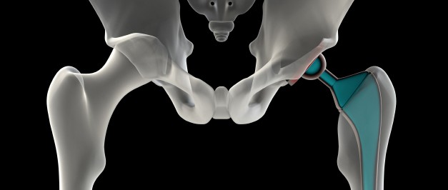 Stryker hip recall