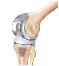 Zimmer knee recall
